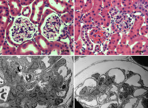 Glomerular thrombotic microangiopathy